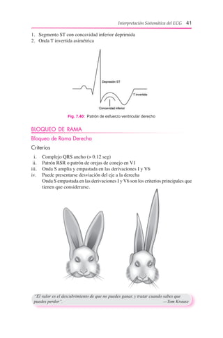 Interpretación Sistemática del ECG 41
1.	 Segmento ST con concavidad inferior deprimida
2.	 Onda T invertida asimétrica
Fig. 7.40:  Patrón de esfuerzo ventricular derecho
BLOQUEO DE RAMA
Bloqueo de Rama Derecha
Criterios
  i.	 	 Complejo QRS ancho (> 0.12 seg)
ii.		 Patrón RSR o patrón de orejas de conejo en V1
iii.		 Onda S amplia y empastada en las derivaciones I y V6
iv.		 Puede presentarse desviación del eje a la derecha
	 	 Onda S empastada en las derivaciones I y V6 son los criterios principales que
tienen que considerarse.
“El valor es el descubrimiento de que no puedes ganar, y tratar cuando sabes que
puedes perder”.	 —Tom Krause
 