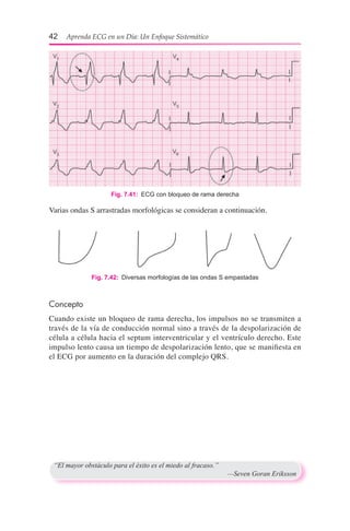 42  Aprenda ECG en un Día: Un Enfoque Sistemático
Concepto
Cuando existe un bloqueo de rama derecha, los impulsos no se transmiten a
través de la vía de conducción normal sino a través de la despolarización de
célula a célula hacia el septum interventricular y el ventrículo derecho. Este
impulso lento causa un tiempo de despolarización lento, que se manifiesta en
el ECG por aumento en la duración del complejo QRS.
Fig. 7.42:  Diversas morfologías de las ondas S empastadas
Fig. 7.41:  ECG con bloqueo de rama derecha
Varias ondas S arrastradas morfológicas se consideran a continuación.
“El mayor obstáculo para el éxito es el miedo al fracaso.”
	 —Seven Goran Eriksson
 