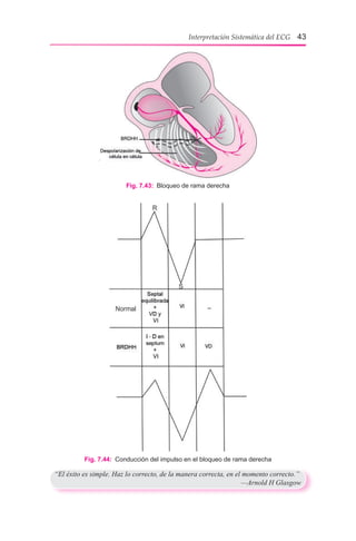 Interpretación Sistemática del ECG 43
Fig. 7.43:  Bloqueo de rama derecha
Fig. 7.44:  Conducción del impulso en el bloqueo de rama derecha
“El éxito es simple. Haz lo correcto, de la manera correcta, en el momento correcto.”
	 —Arnold H Glasgow
 