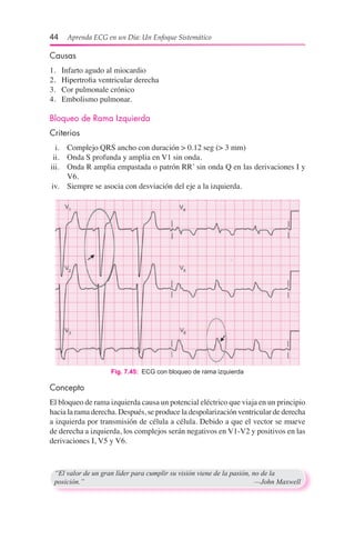 44  Aprenda ECG en un Día: Un Enfoque Sistemático
Causas
1.	 Infarto agudo al miocardio
2.	 Hipertrofia ventricular derecha
3.	 Cor pulmonale crónico
4.	 Embolismo pulmonar.
Bloqueo de Rama Izquierda
Criterios
	 i.	 Complejo QRS ancho con duración > 0.12 seg (> 3 mm)
	ii.	 Onda S profunda y amplia en V1 sin onda.
	iii.	 Onda R amplia empastada o patrón RR’ sin onda Q en las derivaciones I y
V6.
	iv.	 Siempre se asocia con desviación del eje a la izquierda.
Fig. 7.45:  ECG con bloqueo de rama izquierda
Concepto
El bloqueo de rama izquierda causa un potencial eléctrico que viaja en un principio
hacia la rama derecha. Después, se produce la despolarización ventricular de derecha
a izquierda por transmisión de célula a célula. Debido a que el vector se mueve
de derecha a izquierda, los complejos serán negativos en V1-V2 y positivos en las
derivaciones I, V5 y V6.
“El valor de un gran líder para cumplir su visión viene de la pasión, no de la
posición.”	 —John Maxwell
 