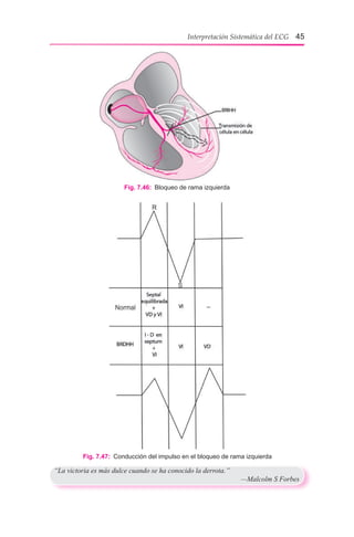 Interpretación Sistemática del ECG 45
Fig. 7.46:  Bloqueo de rama izquierda
Fig. 7.47:  Conducción del impulso en el bloqueo de rama izquierda
“La victoria es más dulce cuando se ha conocido la derrota.”
	 —Malcolm S Forbes
 