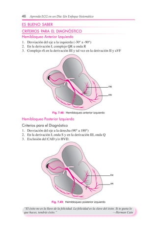 46  Aprenda ECG en un Día: Un Enfoque Sistemático
ES BUENO SABER
CRITERIOS PARA EL DIAGNÓSTICO
Hemibloqueo Anterior Izquierdo
1.	 Desviación del eje a la izquierda (-30° a -90°)
2.	 En la derivación I, complejo QR u onda R
3.	 Complejo rS en la derivación III y tal vez en la derivación II y aVF
Fig. 7.48:  Hemibloqueo anterior izquierdo
Hemibloqueo Posterior Izquierdo
Criterios para el Diagnóstico
1.	 Desviación del eje a la derecha (90° a 180°)
2.	 En la derivación I, onda S y en la derivación III, onda Q
3.	 Exclusión del CAD y/o HVD.
Fig. 7.49:  Hemibloqueo posterior izquierdo
“El éxito no es la llave de la felicidad. La felicidad es la clave del éxito. Si te gusta lo
que haces, tendrás éxito.”	 —Herman Cain
 