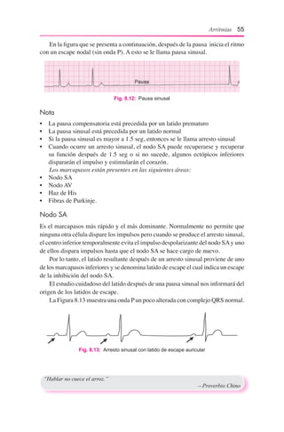 Arritmias 55
	 En la figura que se presenta a continuación, después de la pausa inicia el ritmo
con un escape nodal (sin onda P). A esto se le llama pausa sinusal.
Nota
•	 La pausa compensatoria está precedida por un latido prematuro
•	 La pausa sinusal está precedida por un latido normal
•	 Si la pausa sinusal es mayor a 1.5 seg, entonces se le llama arresto sinusal
•	 Cuando ocurre un arresto sinusal, el nodo SA puede recuperarse y recuperar
su función después de 1.5 seg o si no sucede, algunos ectópicos inferiores
dispararán el impulso y estimularán el corazón.
	 Los marcapasos están presentes en las siguientes áreas:
•	 Nodo SA
•	 Nodo AV
•	 Haz de His
•	 Fibras de Purkinje.
Nodo SA
Es el marcapasos más rápido y el más dominante. Normalmente no permite que
ninguna otra célula dispare los impulsos pero cuando se produce el arresto sinusal,
el centro inferior temporalmente evita el impulso despolarizante del nodo SAy uno
de ellos dispara impulsos hasta que el nodo SA se hace cargo de nuevo.
	 Por lo tanto, el latido resultante después de un arresto sinusal proviene de uno
de los marcapasos inferiores y se denomina latido de escape el cual indica un escape
de la inhibición del nodo SA.
	 El estudio cuidadoso del latido después de una pausa sinusal nos informará del
origen de los latidos de escape.
	 La Figura 8.13 muestra una onda Pun poco alterada con complejo QRS normal.
Fig. 8.12:  Pausa sinusal
Fig. 8.13:  Arresto sinusal con latido de escape auricular
“Hablar no cuece el arroz.”
	 —Proverbio Chino
 