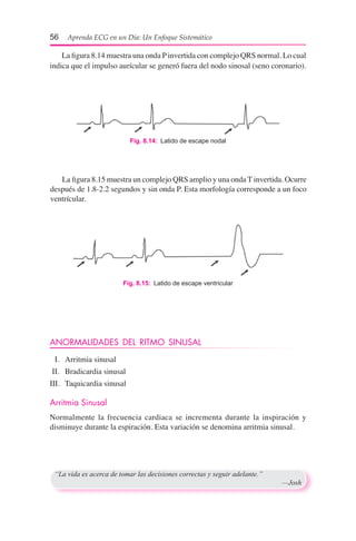 56  Aprenda ECG en un Día: Un Enfoque Sistemático
	 La figura 8.14 muestra una onda Pinvertida con complejo QRS normal. Lo cual
indica que el impulso aurícular se generó fuera del nodo sinosal (seno coronario).
	 La figura 8.15 muestra un complejo QRS amplio y una onda T invertida. Ocurre
después de 1.8-2.2 segundos y sin onda P. Esta morfología corresponde a un foco
ventrícular.
Fig. 8.14:  Latido de escape nodal
ANORMALIDADES DEL RITMO SINUSAL
	 I.	 Arritmia sinusal
	II.	 Bradicardia sinusal
III.	 Taquicardia sinusal
Arritmia Sinusal
Normalmente la frecuencia cardiaca se incrementa durante la inspiración y
disminuye durante la espiración. Esta variación se denomina arritmia sinusal.
Fig. 8.15:  Latido de escape ventricular
“La vida es acerca de tomar las decisiones correctas y seguir adelante.”
	 —Josh
 
