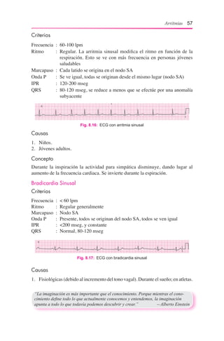 Arritmias 57
Causas
1.	 Niños.
2.	 Jóvenes adultos.
Concepto
Durante la inspiración la actividad para simpática disminuye, dando lugar al
aumento de la frecuencia cardiaca. Se invierte durante la espiración.
Bradicardia Sinusal
Criterios
Frecuencia	 :	 < 60 lpm
Ritmo	 :	 Regular generalmente
Marcapaso	 :	 Nodo SA
Onda P	 :	 Presente, todos se originan del nodo SA, todos se ven igual
IPR	 :	 <200 mseg, y constante
QRS	 :	 Normal, 80-120 mseg
Fig. 8.16:  ECG con arritmia sinusal
Criterios
Frecuencia	 :	 60-100 lpm
Ritmo	 :	 Regular. La arritmia sinusal modifica el ritmo en función de la
respiración. Esto se ve con más frecuencia en personas jóvenes
saludables
Marcapaso	 :	 Cada latido se origina en el nodo SA
Onda P	 :	 Se ve igual, todas se originan desde el mismo lugar (nodo SA)
IPR	 :	 120-200 mseg
QRS	 :	 80-120 mseg, se reduce a menos que se efectúe por una anomalía
subyacente
Fig. 8.17:  ECG con bradicardia sinusal
Causas
1.	 Fisiológicas (debido al incremento del tono vagal). Durante el sueño; en atletas.
“La imaginación es más importante que el conocimiento. Porque mientras el cono-
cimiento define todo lo que actualmente conocemos y entendemos, la imaginación
apunta a todo lo que todavía podemos descubrir y crear.”	 —Alberto Einstein
 