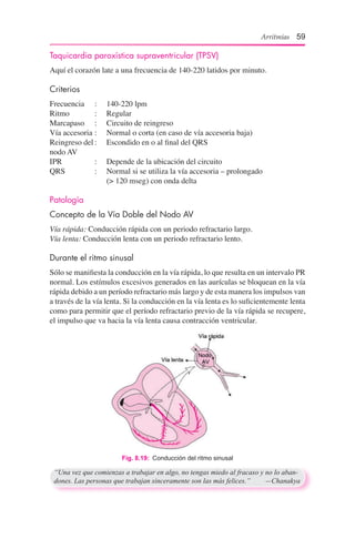 Arritmias 59
Taquicardia paroxística supraventricular (TPSV)
Aquí el corazón late a una frecuencia de 140-220 latidos por minuto.
Criterios
Frecuencia		 :	 140-220 lpm
Ritmo		 :	 Regular
Marcapaso		 :	 Circuito de reingreso
Vía accesoria	:	 Normal o corta (en caso de vía accesoria baja)
Reingreso del	:	 Escondido en o al final del QRS
nodo AV
IPR		 :	 Depende de la ubicación del circuito
QRS		 :	 Normal si se utiliza la vía accesoria – prolongado
	 (> 120 mseg) con onda delta
Patología
Concepto de la Vía Doble del Nodo AV
Vía rápida: Conducción rápida con un periodo refractario largo.
Vía lenta: Conducción lenta con un periodo refractario lento.
Durante el ritmo sinusal
Sólo se manifiesta la conducción en la vía rápida, lo que resulta en un intervalo PR
normal. Los estímulos excesivos generados en las aurículas se bloquean en la vía
rápida debido a un período refractario más largo y de esta manera los impulsos van
a través de la vía lenta. Si la conducción en la vía lenta es lo suficientemente lenta
como para permitir que el período refractario previo de la vía rápida se recupere,
el impulso que va hacia la vía lenta causa contracción ventricular.
Fig. 8.19:  Conducción del ritmo sinusal
“Una vez que comienzas a trabajar en algo, no tengas miedo al fracaso y no lo aban-
dones. Las personas que trabajan sinceramente son las más felices.”	 —Chanakya
 