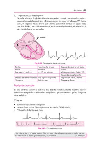 Arritmias 61
Puntos	 Taquicardia sinusal	 Taquicardia supraventricular
Inicio	 Gradual 	 Súbito
Frecuencia cardiaca	 <160 por minuto 	 >160 por minuto (140–220)
		 Responde abruptamente
Masaje del seno carotídeo	 No o poca respuesta	 Palpitación súbita, mareo
Síntomas	 Palpitación	 Síncope y disnea
Fibrilación Auricular
Es una arritmia donde la aurícula late rápida e ineficazmente mientras que el
ventrículo responde a intervalos irregulares, produciendo el pulso irregular
característico.
Criterios
•	 Ritmo irregularmente irregular
•	 Ausencia de ondas P (reemplazadas por ondas f fibrilatorias)
•	 Vibración de la línea de base
Fig. 8.23:  Fibrilación auricular
“La educación es el mejor amigo. Una persona educada es respetada en todas partes.
La educación es mejor que la belleza y la juventud.”	 —Chanakya
3.	 Taquicardia AV de reingreso:
	 Se debe al tracto de derivación (vía accesoria), es decir, un músculo cardíaco
anormal conecta las aurículas y los ventrículos sin pasar por el nodoAV. Desde
aquí, el impulso pasa a través del sistema conductor normal (es decir, nodo
AV, has de His) hacia los ventrículos, reciclando rápidamente por el tracto de
desviación hacia las aurículas.
Fig. 8.22:  Taquicardia AV de reingreso
 