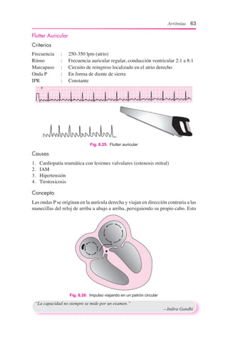 Arritmias 63
Fig. 8.25:  Flutter auricular
Flutter Auricular
Criterios
Frecuencia		 :	 250-350 lpm (atrio)
Ritmo		 :	 Frecuencia auricular regular, conducción ventricular 2:1 a 8:1
Marcapaso		 :	 Circuito de reingreso localizado en el atrio derecho
Onda P		 :	 En forma de diente de sierra
IPR		 :	 Constante
Fig. 8.26:  Impulso viajando en un patrón circular
Causas
1.	 Cardiopatía reumática con lesiones valvulares (estenosis mitral)
2.	 IAM
3.	 Hipertensión
4.	 Tirotoxicosis
Concepto
Las ondas P se originan en la aurícula derecha y viajan en dirección contraria a las
manecillas del reloj de arriba a abajo a arriba, persiguiendo su propio cabo. Esto
“La capacidad no siempre se mide por un examen.”
	 —Indira Gandhi
 