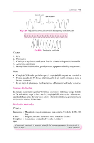 Arritmias 65
Fig. 8.27:  Taquicardia ventricular con latido de captura y latido de fusión
Fig. 8.28:  Taquicardia ventricular
Causas
1.	 IAM
2.	 Miocarditis
3.	 Cardiopatía isquémica crónica con función ventricular izquierda disminuida
4.	 Aneurisma ventricular
5.	 Desequilibrio de electrolitos, principalmente hipopotasemia e hipomagnesemia.
Nota
•	 Complejo QRS ancho que indica que el complejo QRS surge de los ventrículos
•	 Común a partir del IM debido a la formación de un patrón circular en torno a
la zona isquémica
•	 Es un signo de alarma que puede progresar a fibrilación ventricular y muerte.
Torsades De Pointes
En francés, literalmente significa “torsión de los puntos.” Se trata de un tipo distinto
de TV polimórfica.Aquí la dirección del complejo QRS parece rotar cíclicamente,
apuntando hacia abajo durante varios latidos y luego torciéndose y apuntando hacia
arriba en las mismas derivaciones.
Fibrilación Ventricular
Criterios
Frecuencia	 :	 Muy rápido, muy desorganizado para contarlo.Alrededor de 350-500
lpm
Ritmo	 :	 Irregular, la forma de la onda varia en tamaño y forma
Complejos 	:	 Ausencia de segmentos ST, ondas P, ondas T.
QRS
“Cuanto más empinada la montaña más difícil el ascenso pero mejor la vista desde la
línea de meta.”	 —Walt Emerson
 