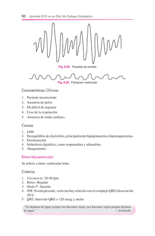 66  Aprenda ECG en un Día: Un Enfoque Sistemático
Características Clínicas
1.	 Paciente inconsciente
2.	 Ausencia de pulso
3.	 PA difícil de registrar
4.	 Cese de la respiración
5.	 Ausencia de ruido cardiaco.
Causas
1.	 IAM
2.	 Desequilibrio de electrolitos, principalmente hipopotasemia e hipomagnesemia.
3.	 Electrocución
4.	 Sobredosis digitálica, como isoprenalina y adrenalina
5.	 Ahogamiento.
Ritmo Idioventricular
Se refiere a ritmo ventricular lento.
Criterios
1.	 Frecuencia: 20-40 lpm
2.	 Ritmo: Regular
3.	 Onda P: Ausente
4.	 IPR: Si está presente, varía (no hay relación con el complejo QRS [disociación
AV])
5.	 QRS: Intervalo QRS > 120 mseg y ancho
“No dejamos de jugar porque nos hacemos viejos, nos hacemos viejos porque dejamos
de jugar.”	 —Aristóteles
Fig. 8.29:  Torsades de pointes
Fig. 8.30:  Fibrilación ventricular
 