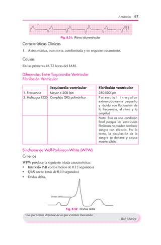 Arritmias 67
Fig. 8.31:  Ritmo idioventricular
Características Clínicas
1.	 Asintomática, transitoria, autolimitada y no requiere tratamiento.
Causas
En las primeras 48-72 horas del IAM.
Diferencias Entre Taquicardia Ventricular
Fibrilación Ventricular
	 Taquicardia ventricular	 Fibrilación ventricular
1. Frecuencia	 Mayor a 200 lpm	 350-500 lpm
3. Hallazgos ECG	 Complejo QRS polimórfico	 P o t e n c i a l i r r e g u l a r
extremadamente pequeño
y rápido con fluctuación de
la frecuencia, el ritmo y la
amplitud
		 Nota: Esta es una condición
fatal porque los ventrículos
fibrilantes no pueden bombear
sangre con eficacia. Por lo
tanto, la circulación de la
sangre se detiene y causa
muerte súbita.
Síndrome de Wolf-Parkinson-White (WPW)
Criterios
WPW produce la siguiente tríada característica:
•	 Intervalo P-R corto (menos de 0.12 segundos)
•	 QRS ancho (más de 0.10 segundos)
•	 Ondas delta.
“Lo que vemos depende de lo que estemos buscando.”
	 —Bob Marley
Fig. 8.32:  Ondas delta
 