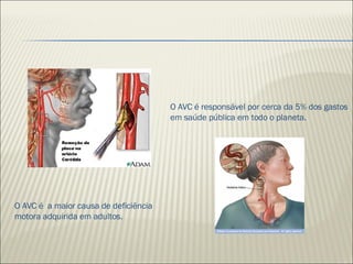 A cada nove segundos, uma pessoa morre de AVC no mundo. O AVC é responsável por cerca da 5% dos gastos em saúde pública em todo o planeta. O AVC é  a maior causa de deficiência motora adquirida em adultos. 