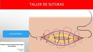 INTRADERMICA
TALLER DE SUTURAS
 