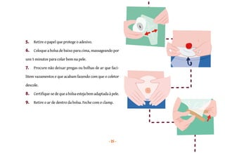 25
5. Retire o papel que protege o adesivo.
6. Coloque a bolsa de baixo para cima, massageando por
uns 5 minutos para colar bem na pele.
7. Procure não deixar pregas ou bolhas de ar que faci-
litem vazamentos e que acabam fazendo com que o coletor
descole.
8. Certifique-se de que abolsaestejabem adaptadaàpele.
9. Retire o ar de dentro da bolsa. Feche com o clamp.
 