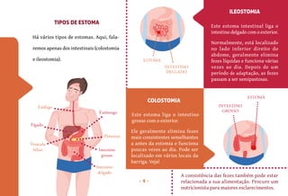 9
Há vários tipos de estomas. Aqui, fala-
remos apenas dos intestinais (colostomia
e ileostomia).
TIPOS DE ESTOMA
Este estoma liga o intestino
grosso com o exterior.
Este estoma intestinal liga o
intestino delgado com o exterior.
Ele geralmente elimina fezes
mais consistentes semelhantes
a antes da estomia e funciona
poucas vezes ao dia. Pode ser
localizado em vários locais da
barriga. Veja!
Normalmente, está localizado
no lado inferior direito do
abdome, geralmente elimina
fezes líquidas e funciona várias
vezes ao dia. Depois de um
período de adaptação, as fezes
passam a ser semipastosas.
COLOSTOMIA
ILEOSTOMIA
Intestino
grosso
Intestino
delgado
Esôfago
Fígado
Vesícula
biliar
Estômago
Pâncreas
INTESTINO
DELGADO
ESTOMA
INTESTINO
GROSSO
ESTOMA
A consistência das fezes também pode estar
relacionada a sua alimentação. Procure um
nutricionista para maiores esclarecimentos.
 