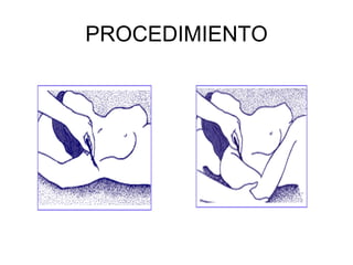 PROCEDIMIENTO 