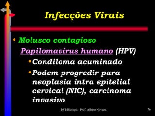 Infecções Virais Molusco contagioso Papilomavírus humano  (HPV) Condiloma acuminado Podem progredir para neoplasia intra epitelial cervical (NIC), carcinoma invasivo 