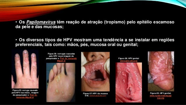Resultado de imagem para hpv