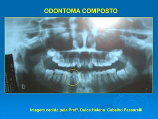 ODONTOMA COMPOSTOImagem cedida pela Profª. Dulce Helena  Cabelho Passarelli