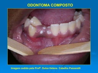 ODONTOMA COMPOSTOImagem cedida pela Profª. Dulce Helena  Cabelho Passarelli