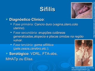 SífilisSífilis
 Diagnóstico ClínicoDiagnóstico Clínico::

Fase primária:Fase primária: Cancro duro (vagina,útero,coloCancro duro (vagina,útero,colo
uterino).uterino).

Fase secundária:Fase secundária: erupções cutâneaserupções cutâneas
generalizadas,alopecia e placas úmidas na regiãogeneralizadas,alopecia e placas úmidas na região
vulvar.vulvar.

Fase terciária:Fase terciária: goma sifilíticagoma sifilítica
(pele,ossos,cérebro,etc.).(pele,ossos,cérebro,etc.).
 SorológicoSorológico: VDRL, FTA-abs,: VDRL, FTA-abs,
MHATp ou Elisa.MHATp ou Elisa.
http://www.saberweb.com.br/do
encas/images/sifilis01.jpg
http://www.saberweb.com.br/doencas/images/sifilis
 