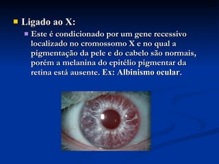 Ligado ao X: Este é condicionado por um gene recessivo localizado no cromossomo X e no qual a pigmentação da pele e do cabelo são normais, porém a melanina do epitélio pigmentar da retina está ausente.   Ex: Albinismo ocular .   
