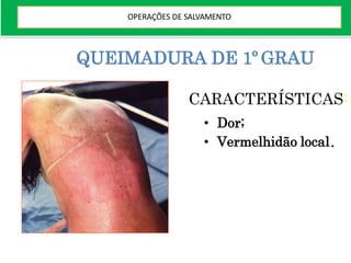 QUEIMADURA DE 1º GRAU
CARACTERÍSTICAS:
• Dor;
• Vermelhidão local.
OPERAÇÕES DE SALVAMENTO
 
