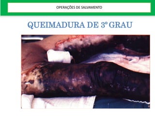 QUEIMADURA DE 3º GRAU
OPERAÇÕES DE SALVAMENTO
 