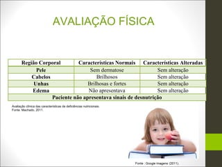 AVALIAÇÃO FÍSICA


       Região Corporal        Características Normais Características Alteradas
             Pele                  Sem dermatose               Sem alteração
           Cabelos                    Brilhosos                Sem alteração
            Unhas                 Brilhosas e fortes           Sem alteração
           Edema                  Não apresentava              Sem alteração
                   Paciente não apresentava sinais de desnutrição
Avaliação clínica das características de deficiências nutricionais.
Fonte: Machado, 2011.
 