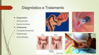 Diagnóstico e Tratamento
 Diagnóstico
• Colonoscopia
• Exame de fezes
 Tratamento
• Cirurgia(Colostomia)
• Radioterapia
• Quimioterapia
 