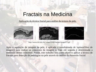 Fractais na Medicina Aplicação da técnica fractal para análise da textura da pele. http://www.inf.ufsc.br/~visao/2000/fractais/image072.gif Após a aquisição da imagem da pele, é aplicada a transformada de laplace(filtro de imagem) para realçar os contornos da imagem e, logo em seguida é determinada a dimensão destes contornos. Assim, este trabalho tem como objetivo aplicar a técnica de fractais para detecção de patologias na pele através da análise da dimensão fractal. 