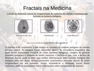Fractais na Medicina Cálculo da dimensão fractal da irregularidade do contorno de células e estruturas que formam os tumores malígnos. http://www.inf.ufsc.br/~visao/2000/fractais/image080.gif O objetivo é de caracterizar a que estágio se encontra os tumores malignos no sistema nervoso central. As imagens foram adquiridas através de ressonância magnética, das quais foram comparadas imagens de cistos (tumores benignos), imagens de gliomas (tumores malignos) e imagens de lesões massivas. Concluiu-se que, com a técnica da dimensão fractal, pode-se obter uma melhor diferenciação entre tumores benignos dos malignos pelo fato destes últimos possuírem característica marcante através de maior irregularidade em seu contorno. Assim, extraindo-se a dimensão fractal destes contornos, pode-se futuramente inferir informações sobre malignidade de tumores. Detecção de um cisto  Glioblastoma  Lesão Massiva 