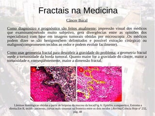 Câncer Bucal Como diagnóstico e prognóstico são feitos atualmente:   i mpressão visual dos médicos que examinam(método muito subjetivo, gera divergências entre as opiniões dos especialistas) com base em imagens tumorais obtidas por microscopia .Os médicos podem dizer se são benignos(bem delimitados e possível extração cirúrgica) ou malignos(comprometem tecidos ao redor e podem evoluir facilmente). Como usar geometria fractal para descobrir a gravidade do problema:  a geometria fractal mede a tortuosidade da borda tumoral. Quanto maior for a gravidade do câncer, maior a tortuosidade e, conseqüêntemente, maior a dimensão fractal. Fractais na Medicina Lâminas histológicas obtidas a partir de biópsias da mucosa da boca(Fig A: Epitélio, a esquerda e, Estroma a direita.Em B, tecido canceroso, curvas mais sinuosas na fronteira entre os dois tecidos ).Revista Ciência Hoje nº 232, pág. 48  