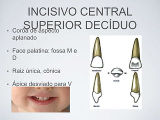 INCISIVO CENTRAL
SUPERIOR DECÍDUO• Corôa de aspecto
aplanado
• Face palatina: fossa M e
D
• Raiz única, cônica
• Ápice desviado para V
 
