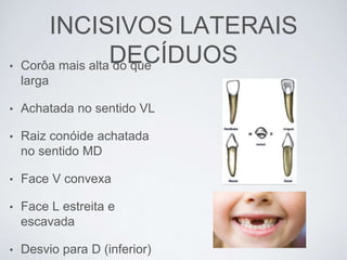 INCISIVOS LATERAIS
DECÍDUOS• Corôa mais alta do que
larga
• Achatada no sentido VL
• Raiz conóide achatada
no sentido MD
• Face V convexa
• Face L estreita e
escavada
• Desvio para D (inferior)
 