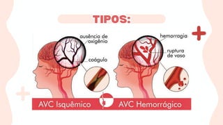 Apresentação Acidente Vascular Encefálico (AVC/AVE) | PDF