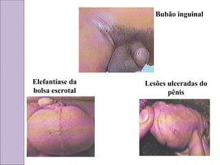 Bubão inguinal
Elefantíase da
bolsa escrotal
Lesões ulceradas do
pênis
 