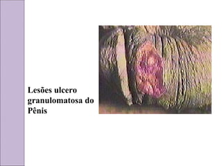 Lesões ulcero
granulomatosa do
Pênis
 
