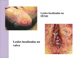 Lesões localizadas no 
PÊNIS 
Lesões localizadas na 
vulva 
 