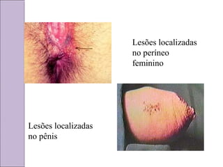 Lesões localizadas 
no períneo 
feminino 
Lesões localizadas 
no pênis 
 