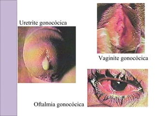 Uretrite gonocócica 
Vaginite gonocócica 
Oftalmia gonocócica 
 