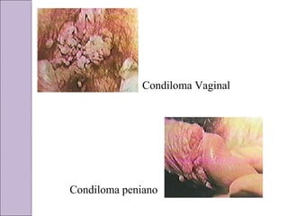 Condiloma Vaginal 
Condiloma peniano 
 