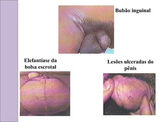 Bubão inguinal 
Elefantíase da 
bolsa escrotal 
Lesões ulceradas do 
pênis 
 