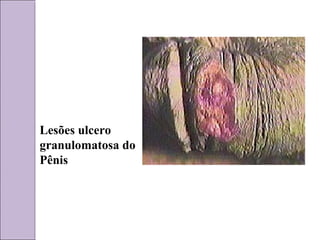 Lesões ulcero 
granulomatosa do 
Pênis 
 