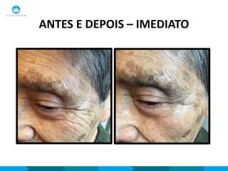 ANTES E DEPOIS – IMEDIATO
 