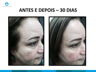 ANTES E DEPOIS – 30 DIAS
 