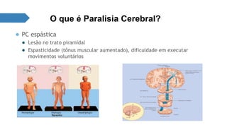 O que é Paralisia Cerebral? 
● PC espástica 
● Lesão no trato piramidal 
● Espasticidade (tônus muscular aumentado), dificuldade em executar 
movimentos voluntários 
 