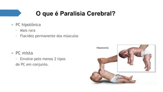 O que é Paralisia Cerebral? 
• PC hipotônica 
– Mais rara 
– Flacidez permanente dos músculos 
• PC mista 
– Envolve pelo menos 2 tipos 
de PC em conjunto. 
 