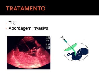 • TIU
• Abordagem invasiva
 