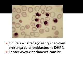 Figura 1 – Esfregaço sanguíneo com
presença de eritroblastos na DHRN.
 Fonte: www.ciencianews.com.br
 
